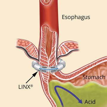Image showing how LINX magnets work to prevent reflux