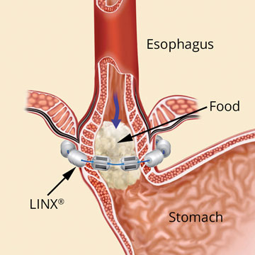Image showing how LINX lets food pass into the stomach